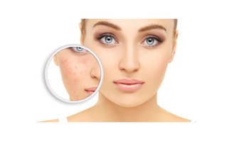 Rosacea-Behandlung