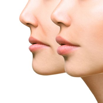 Nasolabial Filling